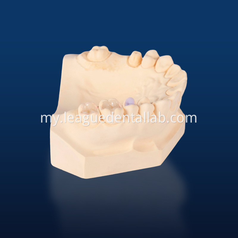 PFZ,Porcelain Fused to Zirconia,Zirconia Layered, Zirconia Veneered